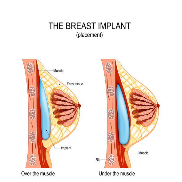 Breast implant placement diagram