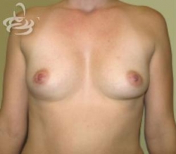 Breast Augmentation Before and After | Valencia Plastic Surgery