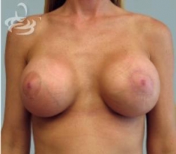 Breast Lift Before and After | Valencia Plastic Surgery