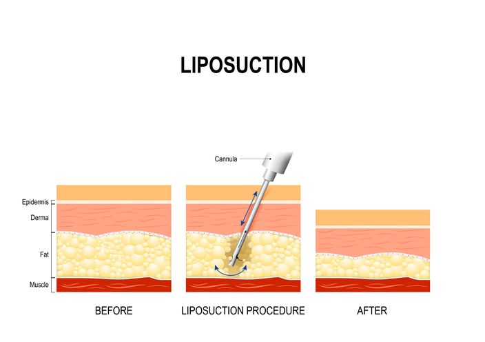 Diagram of before and after liposuction