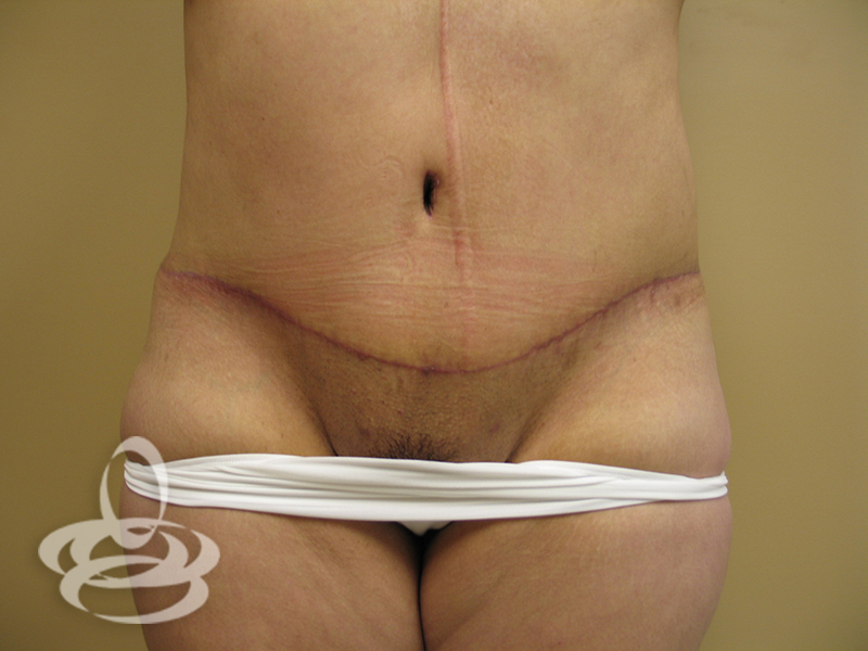 Abdominoplasty With Flank Liposuction Before and After | Valencia Plastic Surgery