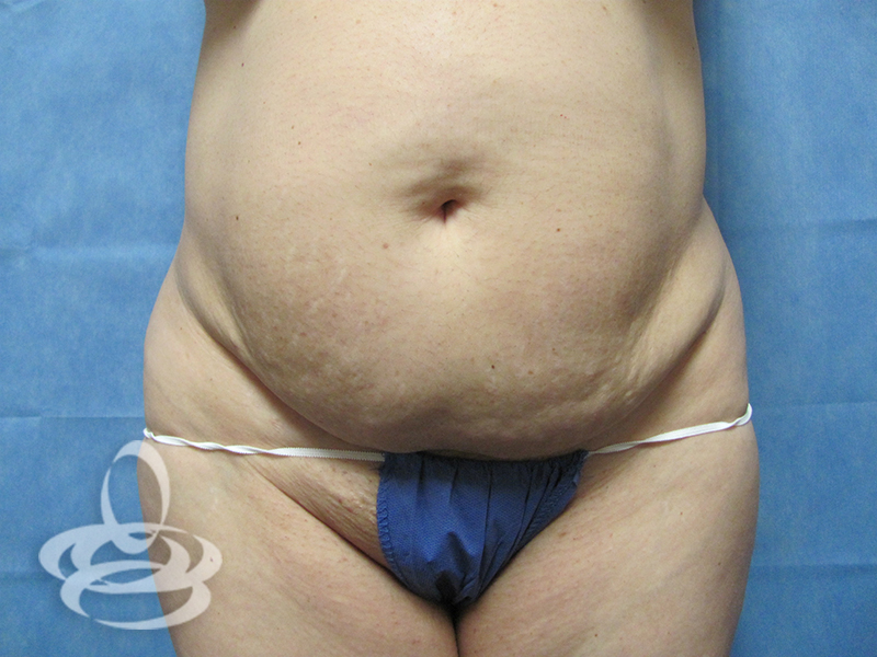 Abdominoplasty With Flank Liposuction Before and After | Valencia Plastic Surgery