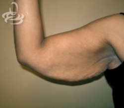 Arm Lift Before and After | Valencia Plastic Surgery