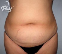 Liposuction Before and After | Valencia Plastic Surgery