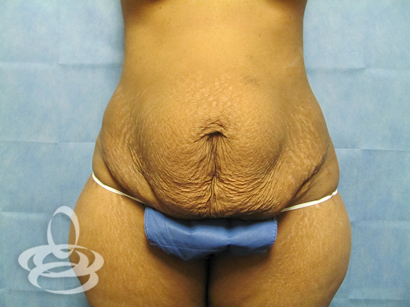 Tummy Tuck Before and After | Valencia Plastic Surgery