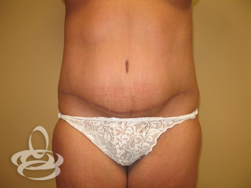 Tummy Tuck Before and After | Valencia Plastic Surgery