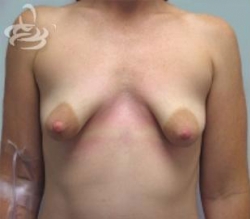 Breast Correction Before and After | Valencia Plastic Surgery
