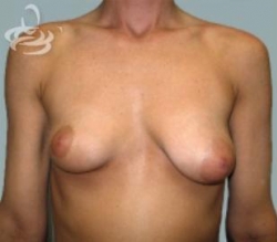 Breast Lift Before and After | Valencia Plastic Surgery