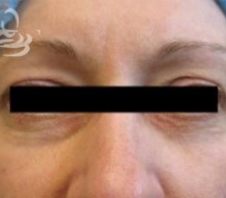 Eyelid Surgery Before and After | Valencia Plastic Surgery