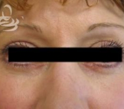 Eyelid Surgery Before and After | Valencia Plastic Surgery