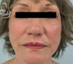 Facelift Before and After | Valencia Plastic Surgery