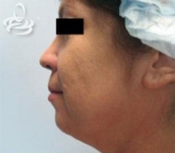 Necklift Before and After | Valencia Plastic Surgery