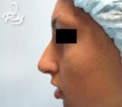 Rhinoplasty Before and After | Valencia Plastic Surgery