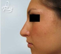Rhinoplasty Before and After | Valencia Plastic Surgery